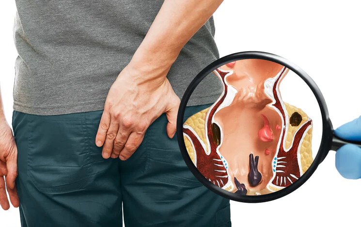 PIles/Mulvyadh Treatment in Pimpri Chinchwad, Pune